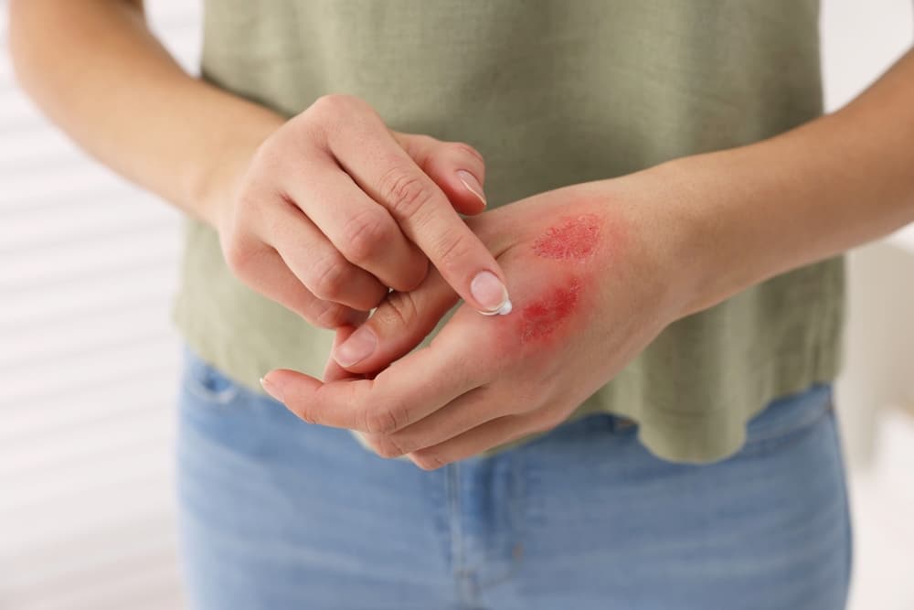 Woman applying healing cream onto burned hand