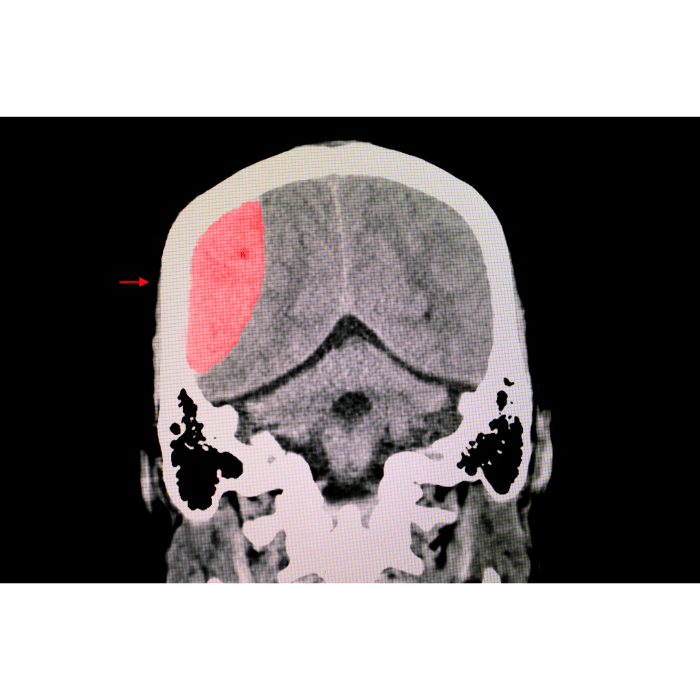 Myrtle Beach Traumatic Brain Injury (TBI) Lawyer