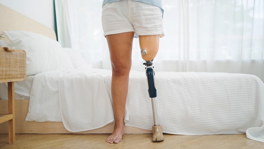 woman with prosthetic leg standing in front of a white bed