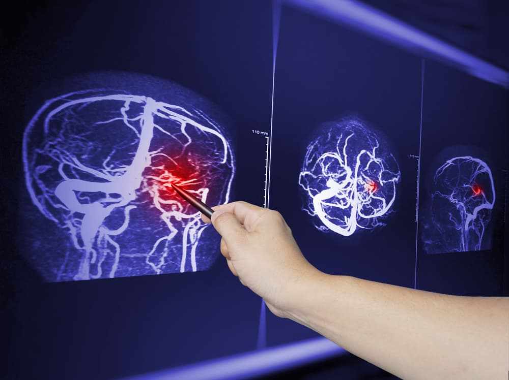 doctor showing a traumatic brain injury xray